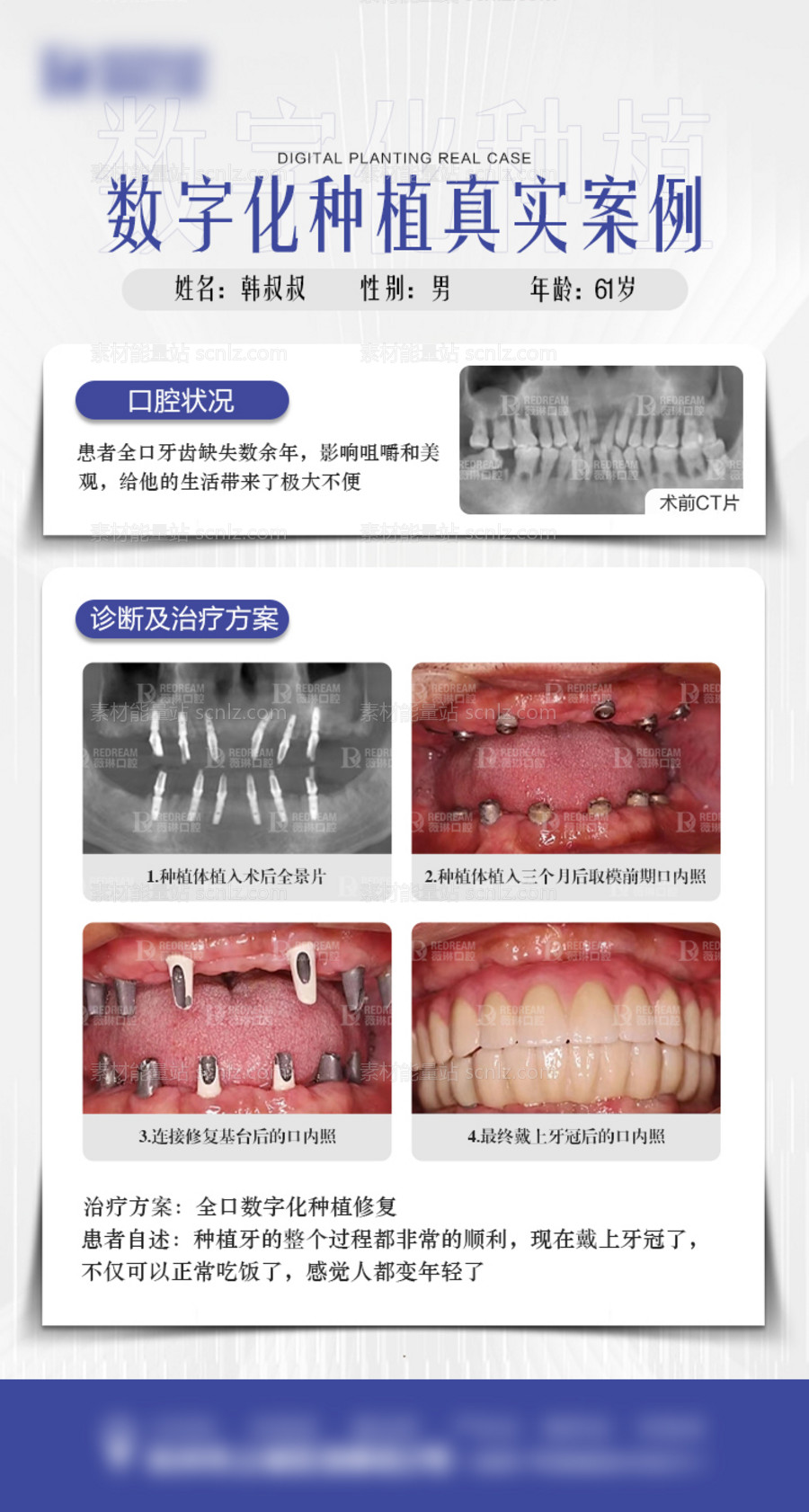 素材能量站-数字化种植牙案例