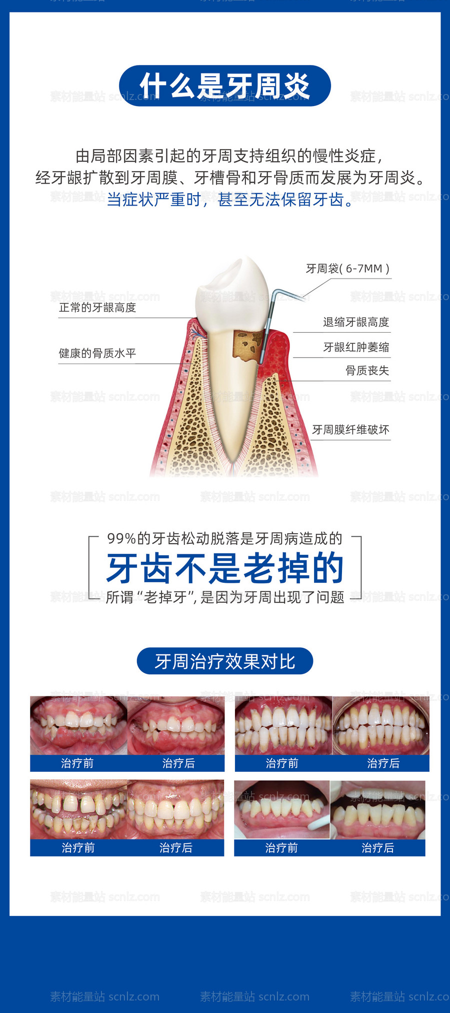 素材能量站-牙周炎易拉宝