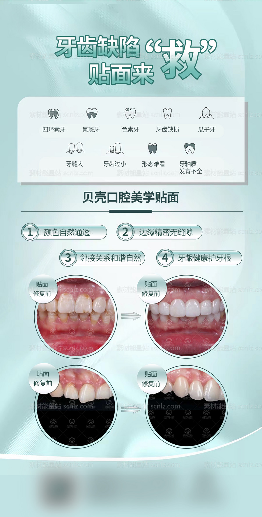 素材能量站-牙齿贴面