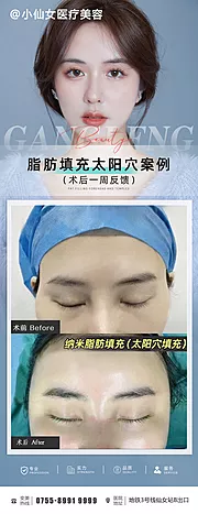 素材能量站-医美整形脂肪填充太阳穴案例